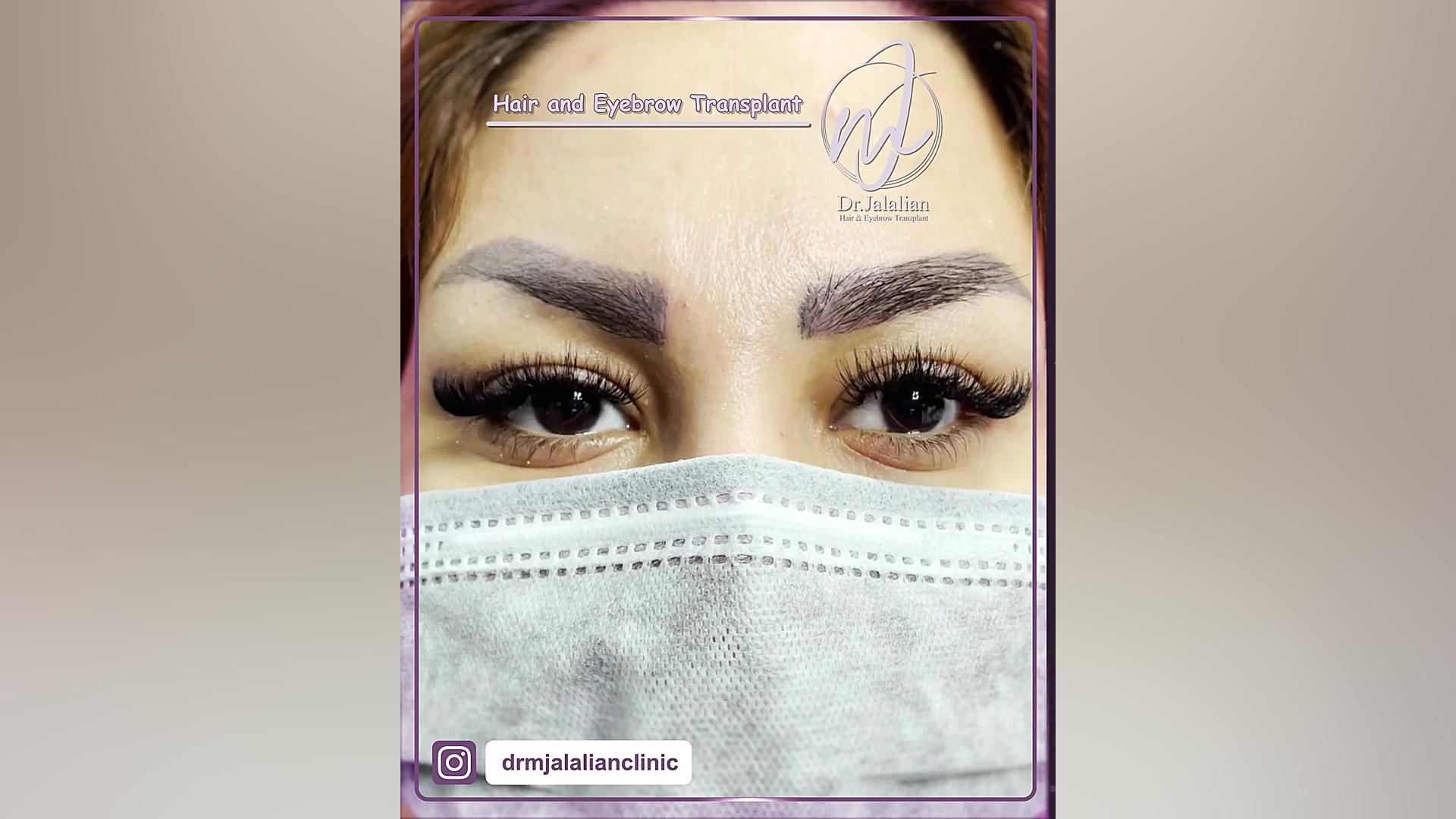 نمونه کار == کلینیک زیبایی دکتر جلالیان بیماری اپیدرمولیز بولوزا