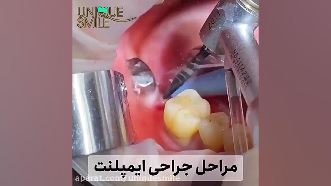 اوردنچر ( پروتز بر پایه ایمپلنت ) دستگاه DNA-Chip