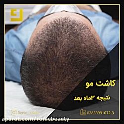 کاشت مو با تراکم بالا کلینیک رونیک