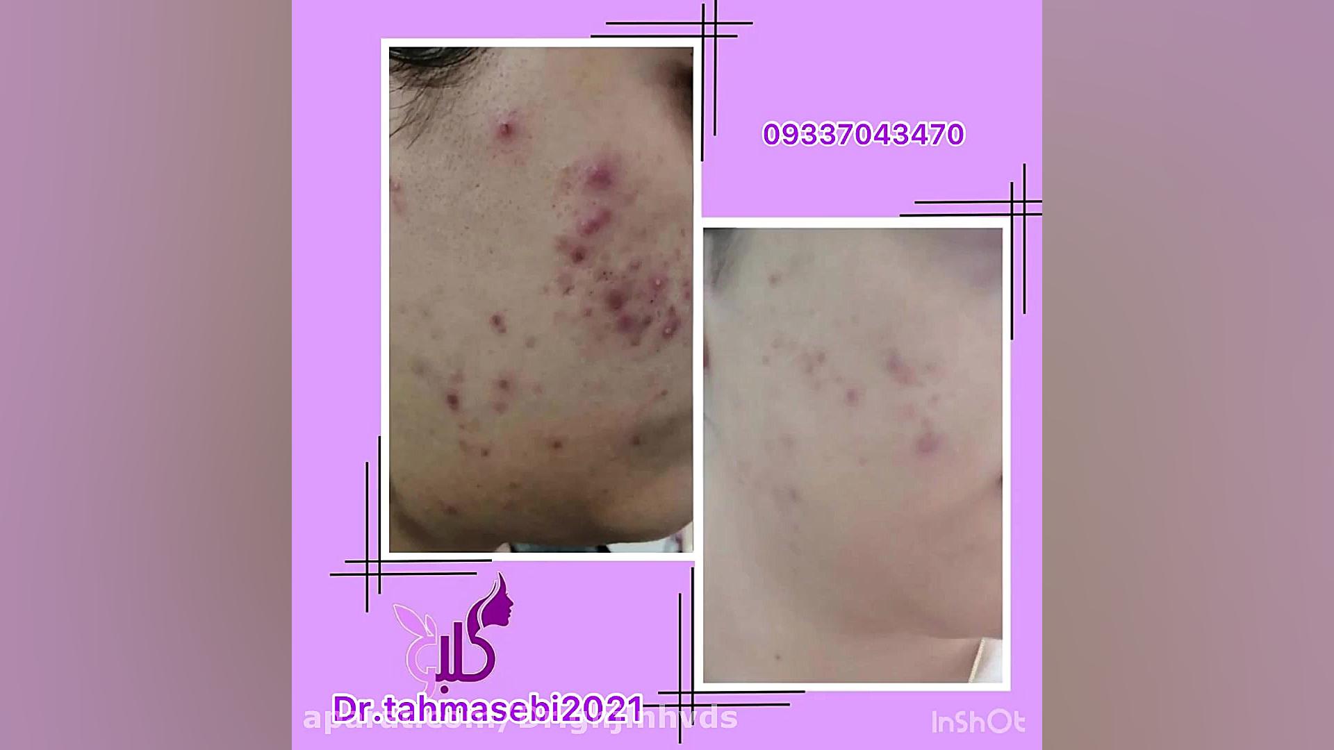 درمان جای جوش و چال و آکنه پوست صورت اصلاح طرح لبخند