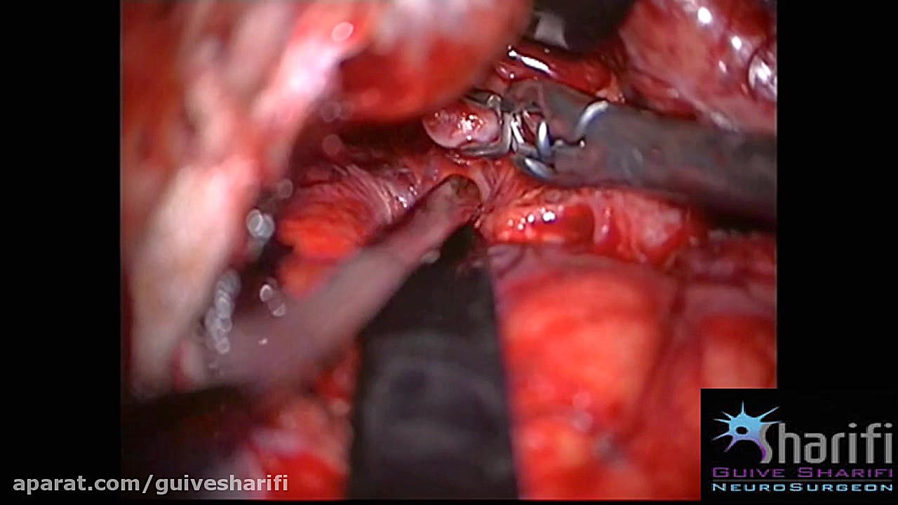6.جراحی میکروسکوپیک آنوریسم مغزی- Aneurysm Clipping روکش دندان