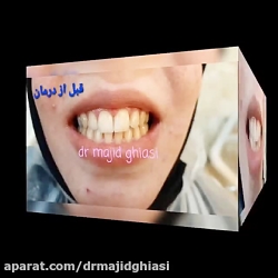 بلیچینگ  دندان