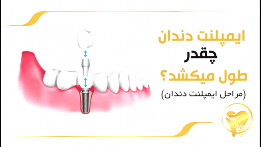ایمپلنت دندان چقدر طول میکشد؟ | مراحل ایمپلنت دندان دکتر عزیز گشاده رو رزولین