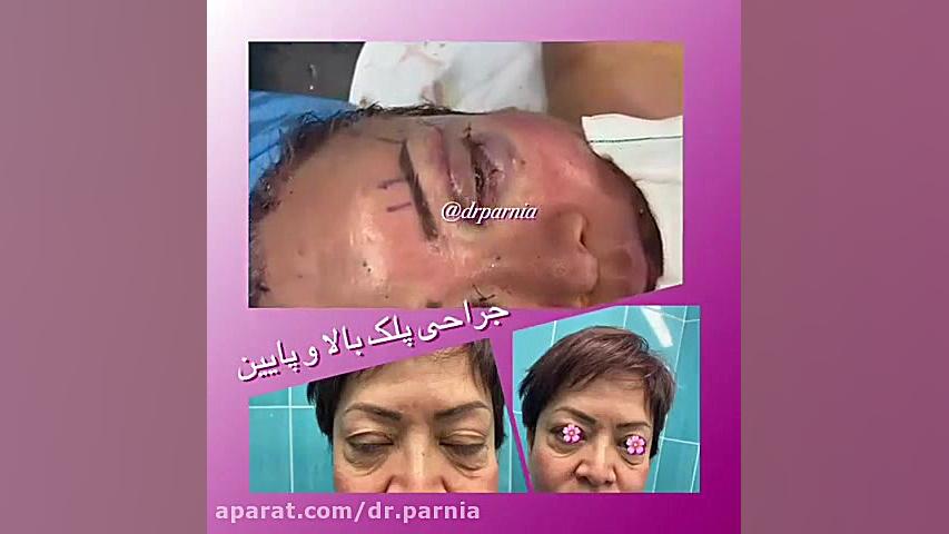جراحی پلک بالا و پلک پایین دکتر رفیع پرنیا فوق تخصص پلاستیک