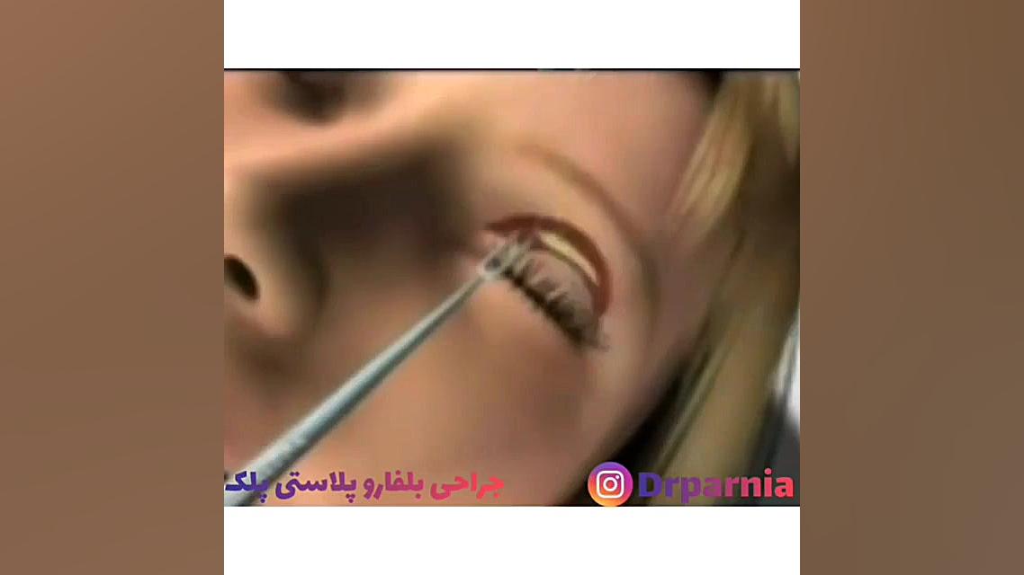بلفاروپلاستی دکتر رفیع پرنیا فوق تخصص پلاستیک