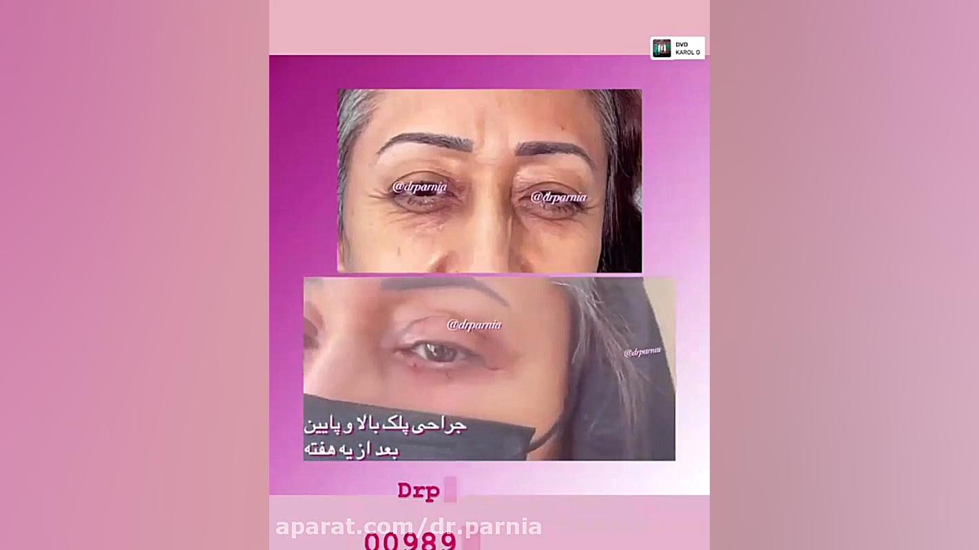 جراحی پلک بالا و پایین دکتر رفیع پرنیا فوق تخصص پلاستیک