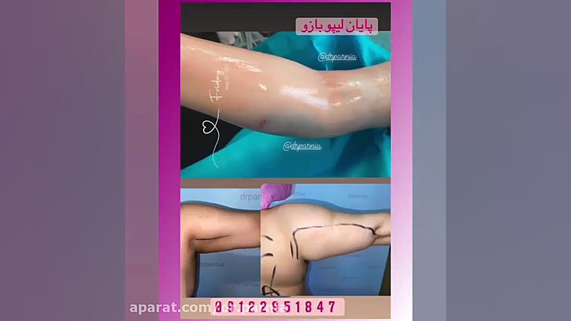 جراحی لیپو و لیفت بازو دکتر رفیع پرنیا فوق تخصص پلاستیک