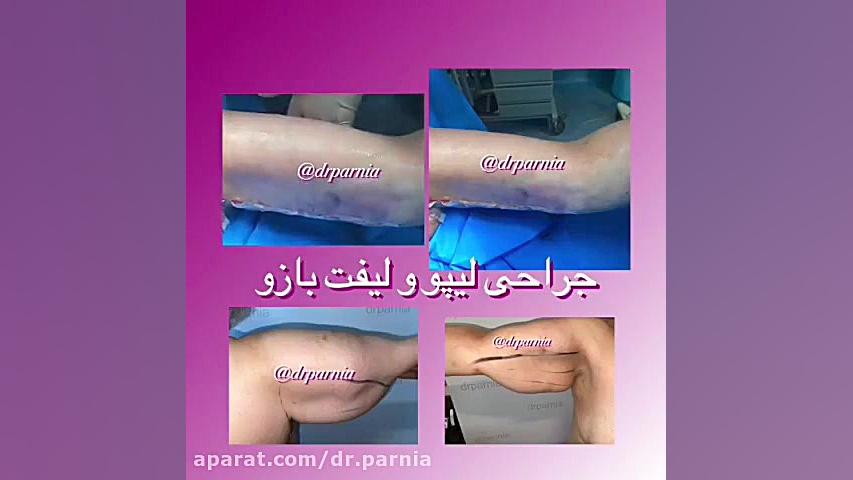 جراحی لیپو و لیفت بازو دکتر رفیع پرنیا فوق تخصص پلاستیک