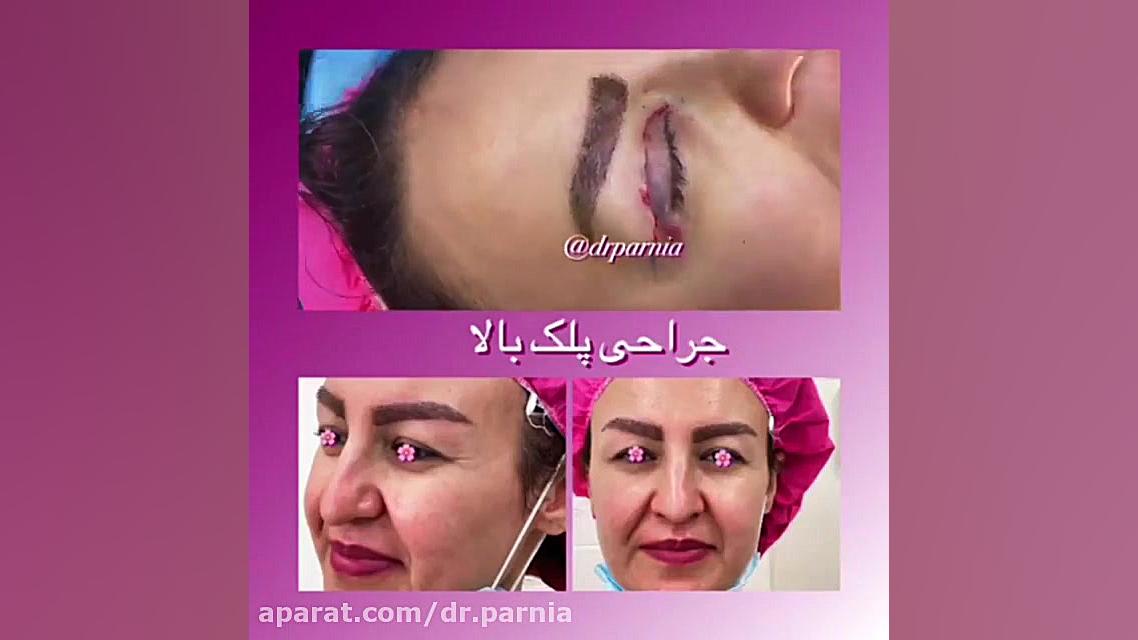 بلفاروپلاستی دکتر رفیع پرنیا فوق تخصص پلاستیک