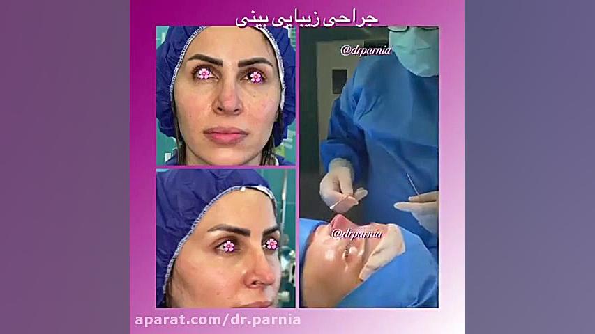 جراحی زیبایی بینی دکتر رفیع پرنیا فوق تخصص پلاستیک