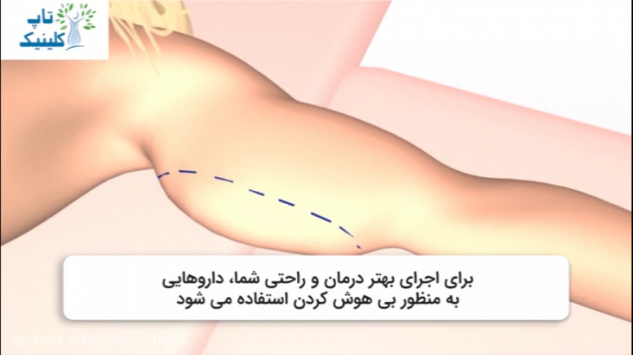 چگونگی عمل لیپوماتیک بازو پزشکی نانوذره‌ای