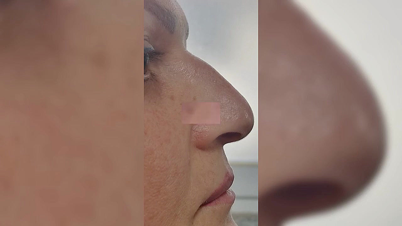 جراحی های زیبایی صورت لیفت شقیقه و ابرو، چال گونه، اتوپلاستی، بلفاروپلاستی، لیپو کاشت ریش