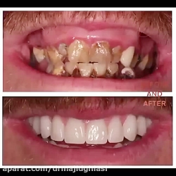 اصلاح طرح لبخند