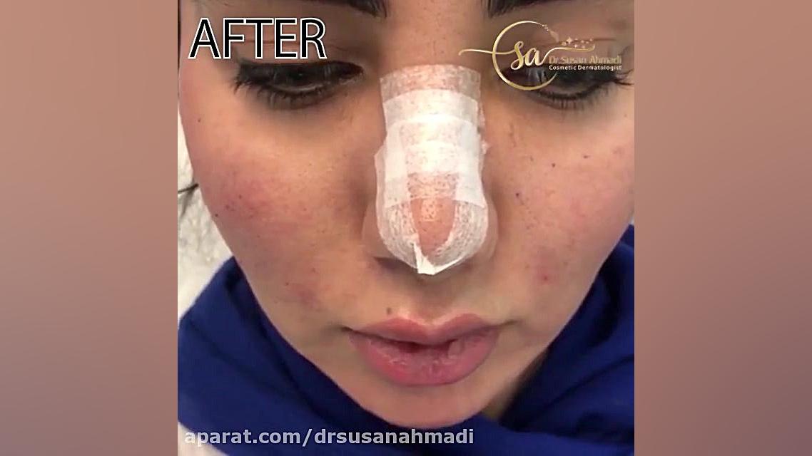 فیلم واقعی تزریق چربی و فرم دهی صورت دکتر سوسن احمدی پیر شهید