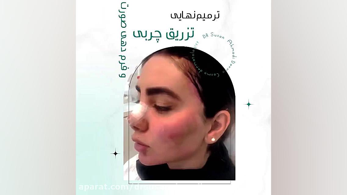 فیلم نتیجه نهایی فرم دهی ویدئوی قبل دکتر سوسن احمدی پیر شهید