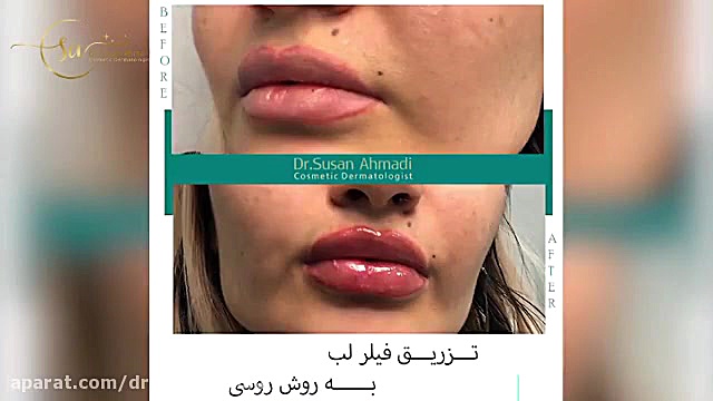 فیلم واقعی تزریق فیلر لب روسی دکتر سوسن احمدی پیر شهید