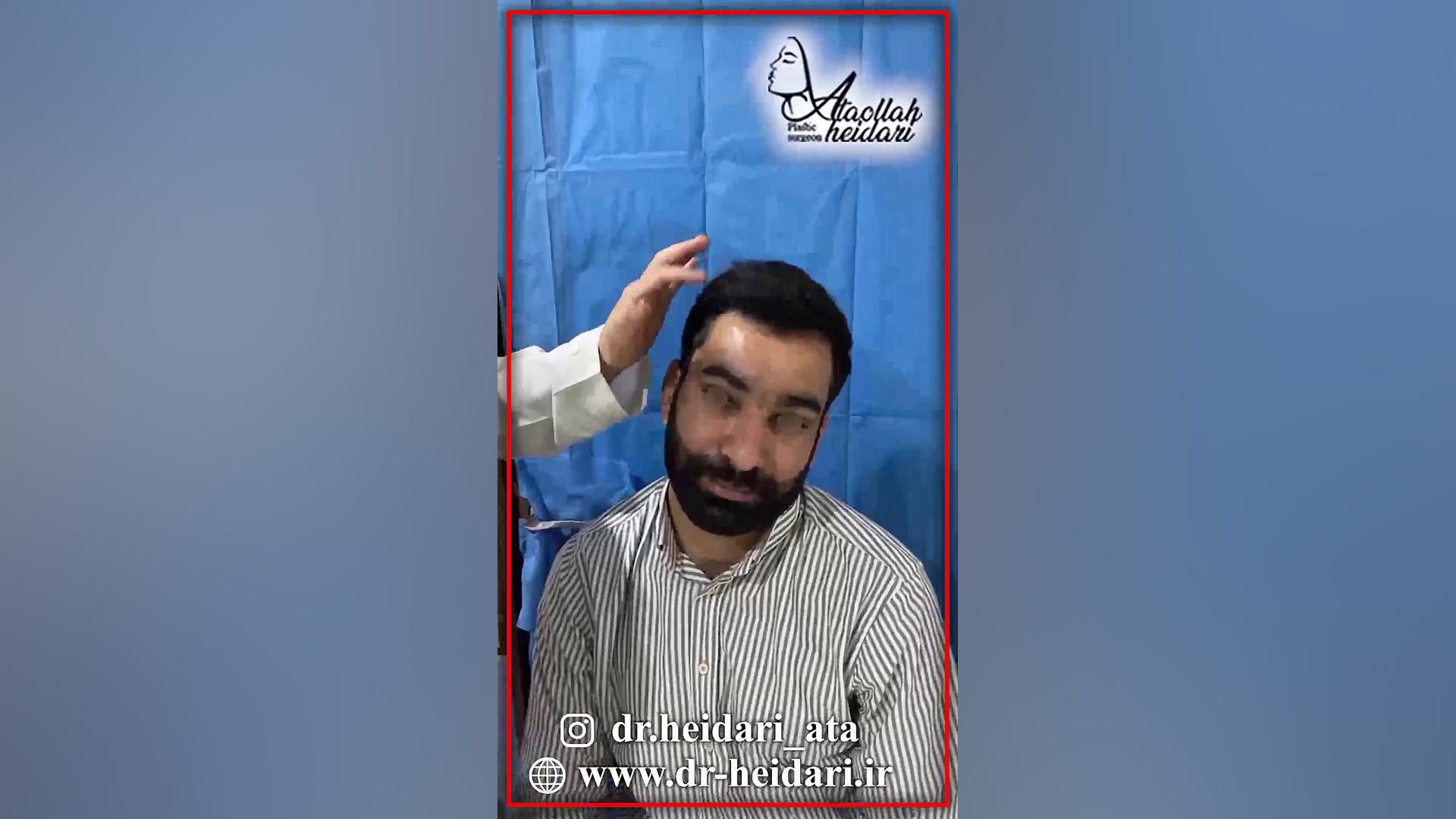 لیفت آندوسکوپی پیشانی با استفاده از اندوتاین درمان سلولیت