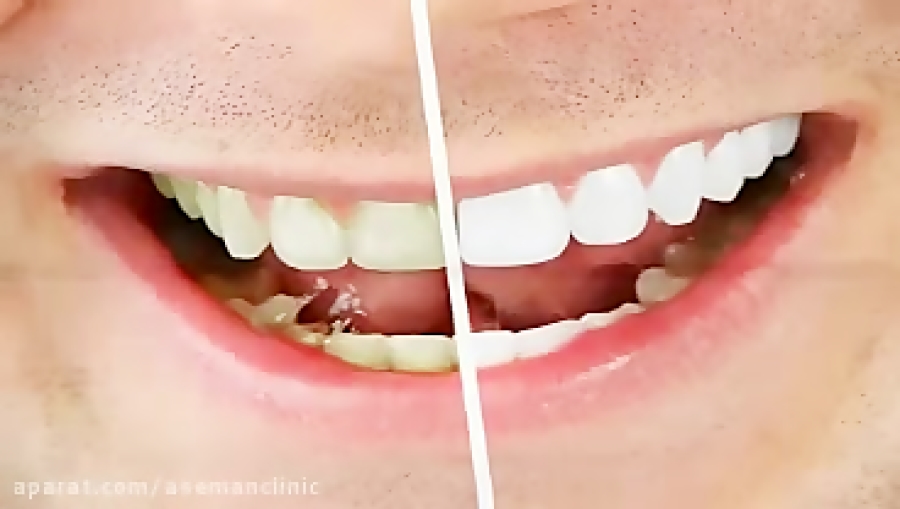 What is Teeth Bleaching? | بلیچینگ چیست؟ Organoid Viability Test