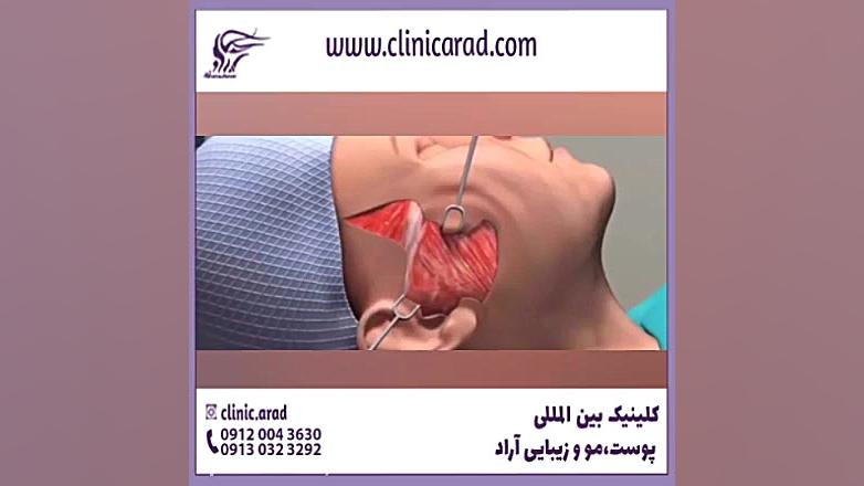 بهترین عمل زیبایی صورت چیست ریبوسیکلیب