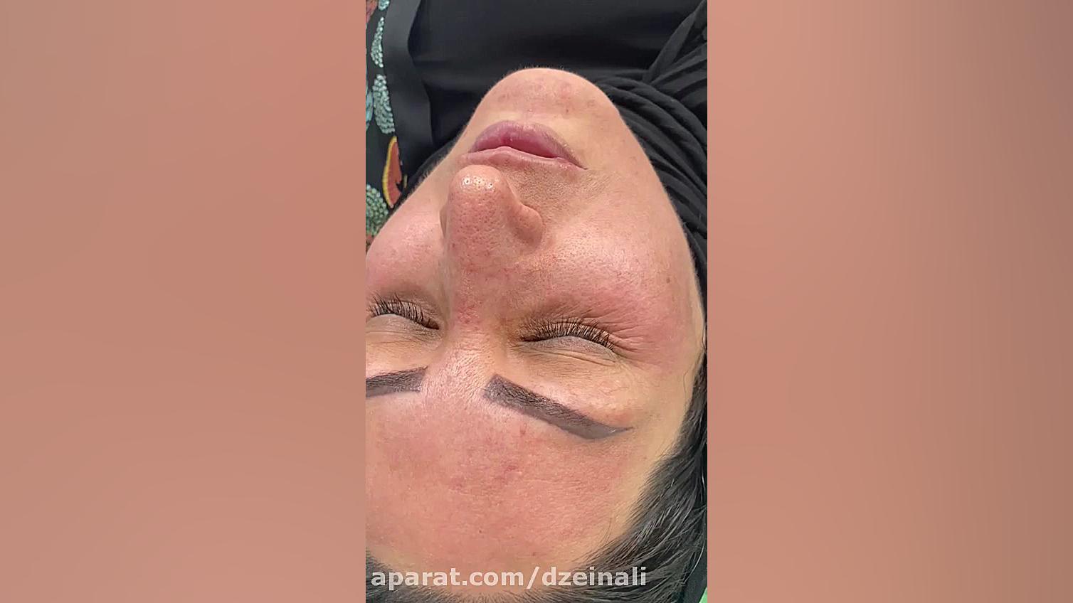 بهبود عالی لکها و کک و مک پوست صورت با لیزرهای تخصصی و مزوژل دکتر فرحناز زینعلی - متخصص پوست، مو، زیبایی زنجان