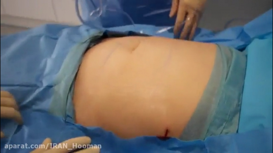 فیلم انجام جراحی لیپوماتیک شکم. اکتروپیون