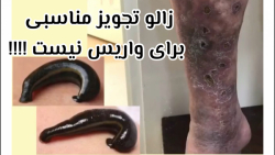 زالو تجویز مناسبی برای واریس نیست !!!! زالو تجویز مناسبی برای واریس نیست !!!!