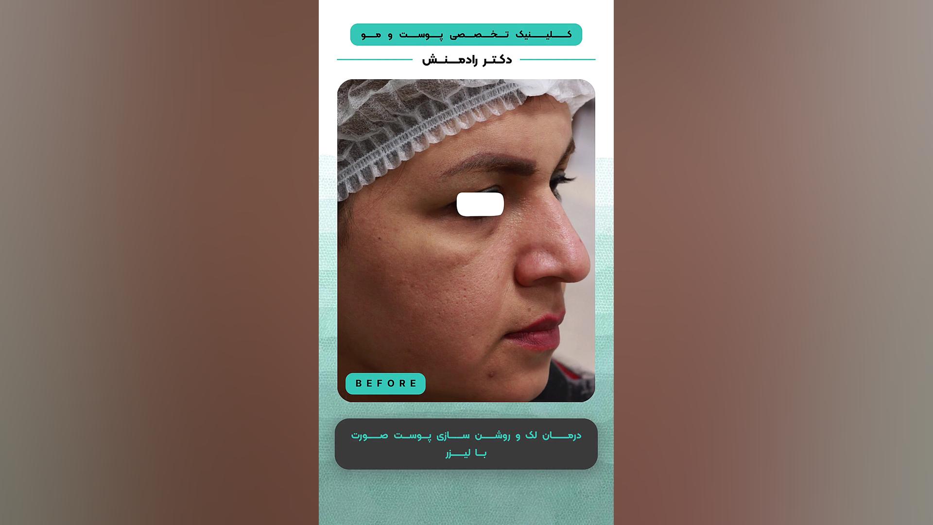 درمان لک و روشن سازی پوست صورت بالیزر کلینیک دندانپزشکی