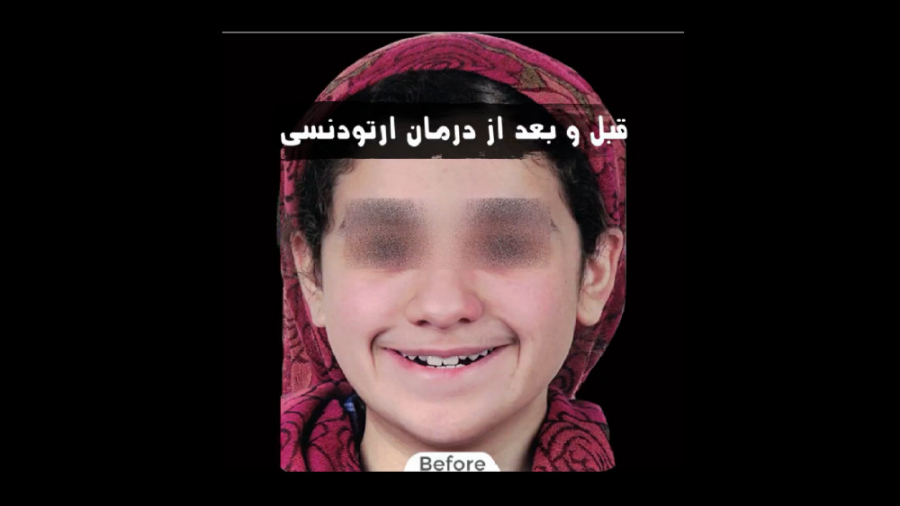 درمان ارتودنسی ثابت فک بالا و پایین بدون کشیدن دندان دکتر برهمن سبزواری - متخصص ارتودنسی - مشهد