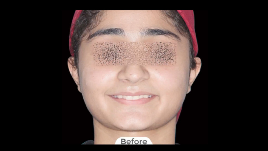 درمان ارتودنسی ثابت فک بالا و پایین بدون کشیدن دندان دکتر برهمن سبزواری - متخصص ارتودنسی - مشهد