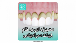 مراحل انجام لمینت سرامیکی