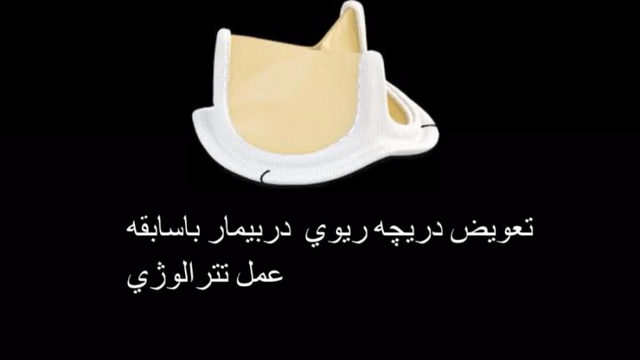 تعویض دریچه ریوی با دریچه حیوانی،دكترحدادزاده عصب‌کشی