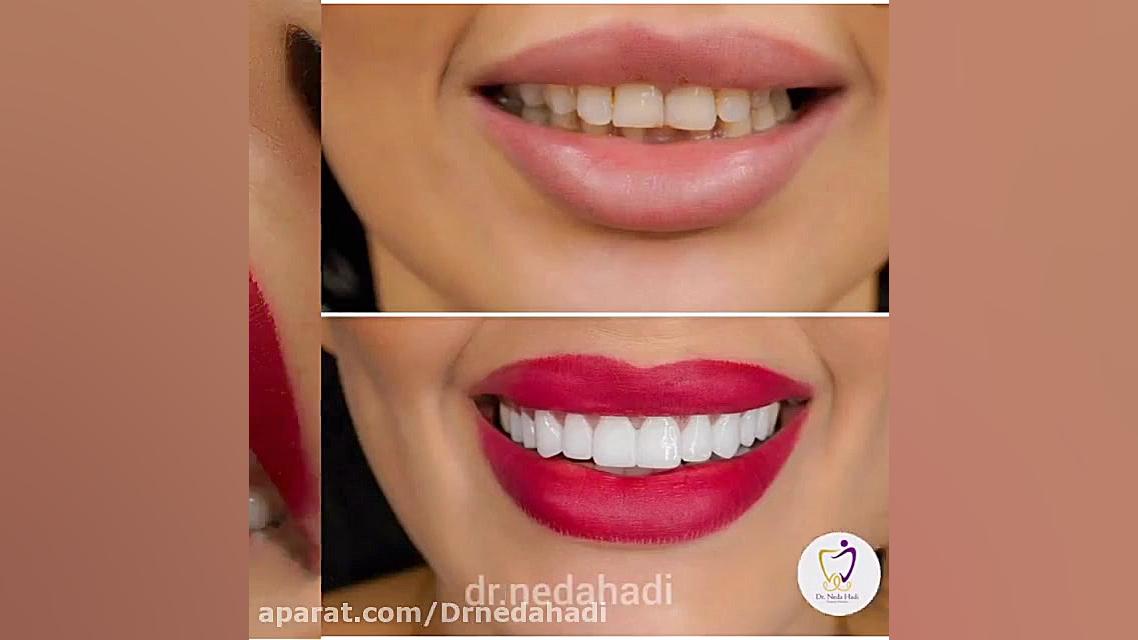 فیلم واقعی از انجام لمنیت و روکش دندان توسط دکتر ندا هادی دکتر ندا هادی-دندانپزشک زیبایی