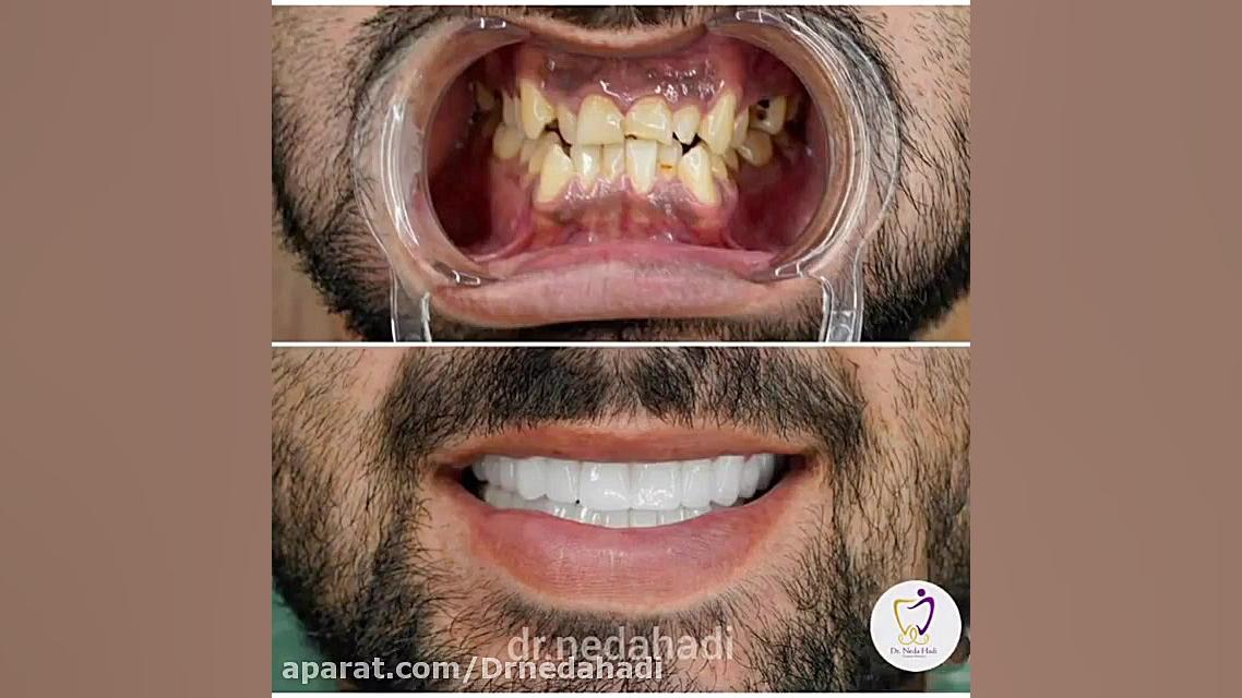 نحوه انجام لمینت و روکش سرامیکی دکتر ندا هادی-دندانپزشک زیبایی