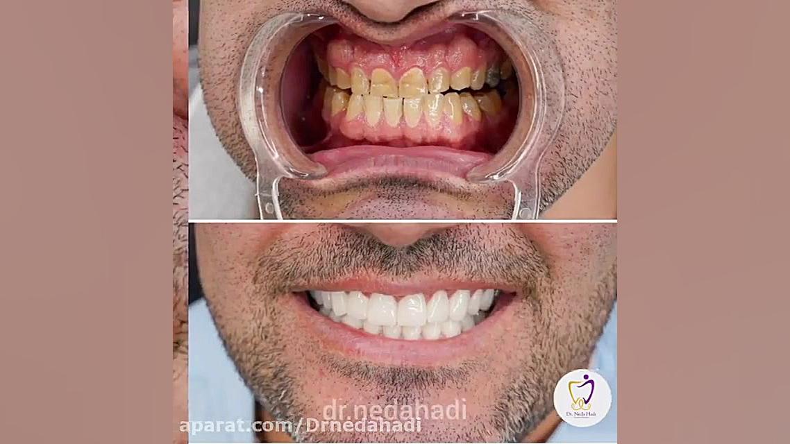 انجام کار زیبایی دندان لمینت هر دو فک در مطب دکتر ندا هادی دکتر ندا هادی-دندانپزشک زیبایی