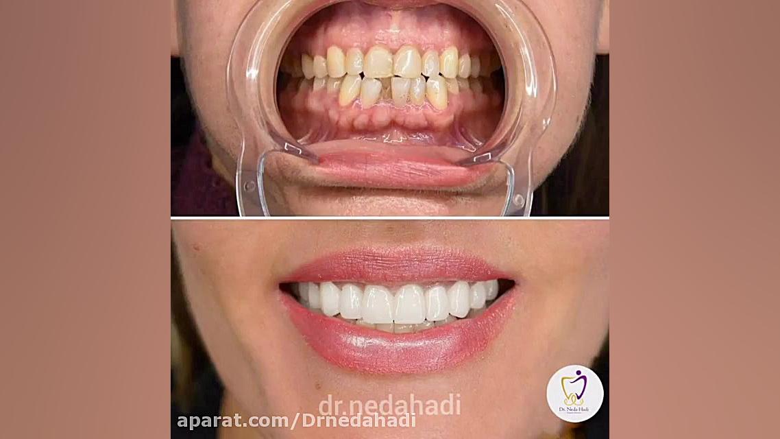 نتیجه واقعی و بسیار زیبا از کار زیبایی دندان دکتر ندا هادی-دندانپزشک زیبایی