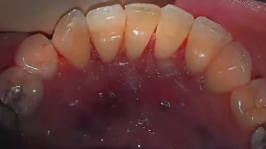 فیلم واقعی درمان تحلیل لثه دکتر احسان بیرنگ