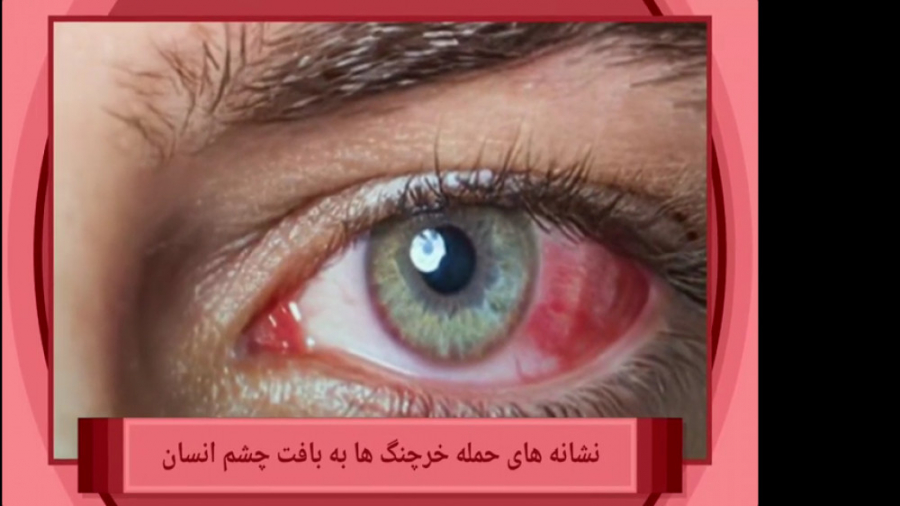 کلیپ / آنچه که باید درباره سرطان چشم بدانیم چای خور چای