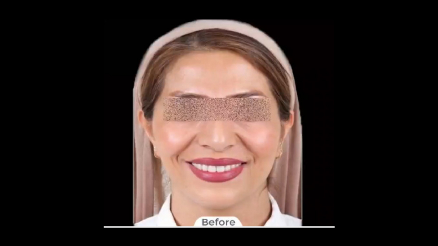 درمان ارتودنسی ثابت فک بالا و پایین با کشیدن یک دندان دکتر برهمن سبزواری - متخصص ارتودنسی - مشهد