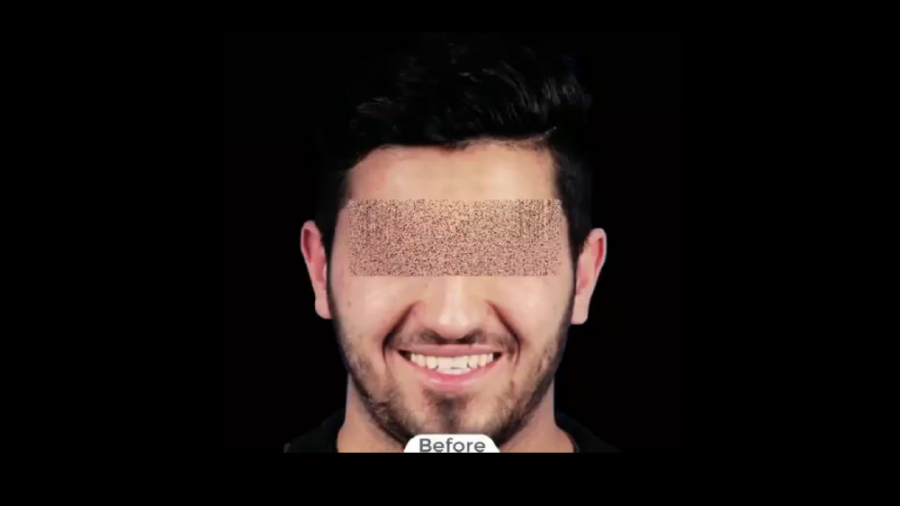 ارتودنسی ثابت فک بالا و پایین بدون کشیدن دندان دکتر برهمن سبزواری - متخصص ارتودنسی - مشهد