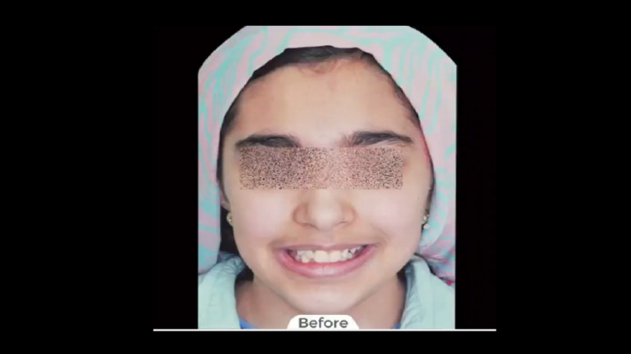 درمان ارتودنسی ثابت با کشیدن چهار دندان دکتر برهمن سبزواری - متخصص ارتودنسی - مشهد