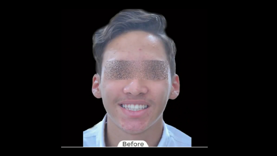 درمان ارتودنسی ثابت با کشیدن یک دندان دایمی دکتر برهمن سبزواری - متخصص ارتودنسی - مشهد