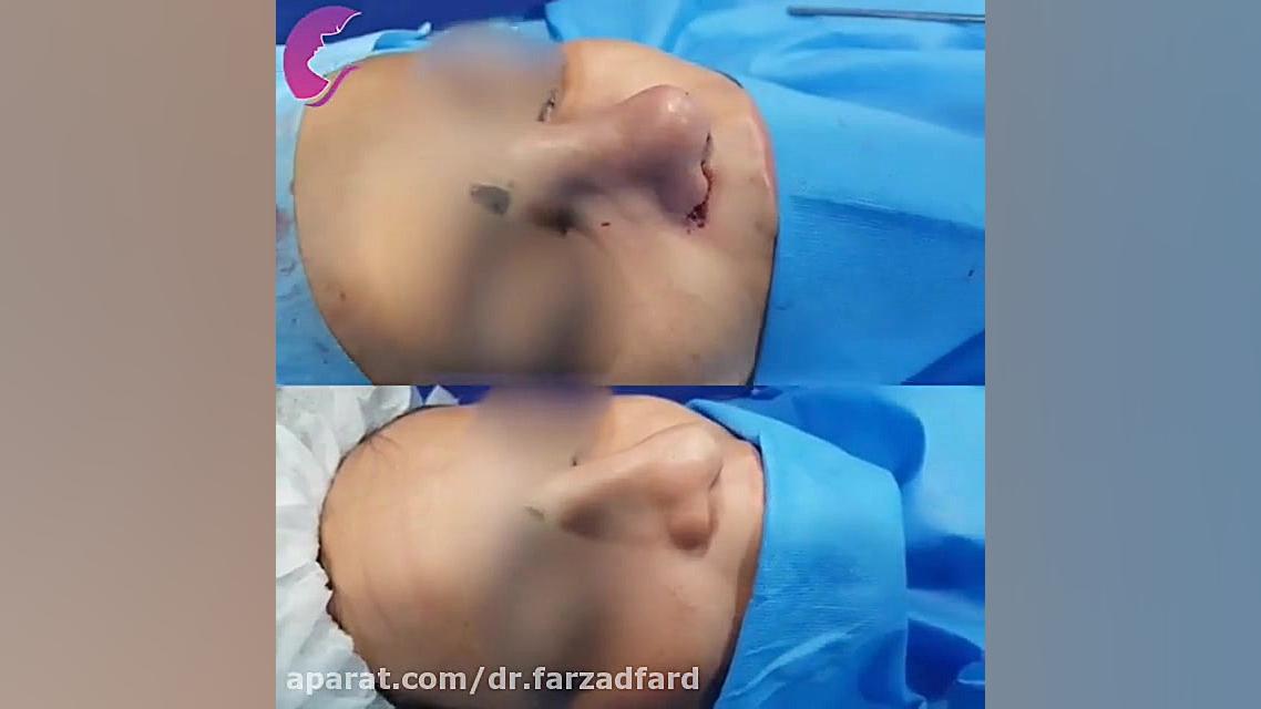 فیلم واقعی عمل بینی دکتر اسماعیل فرزاد فرد - فوق تخصص پلاستیک