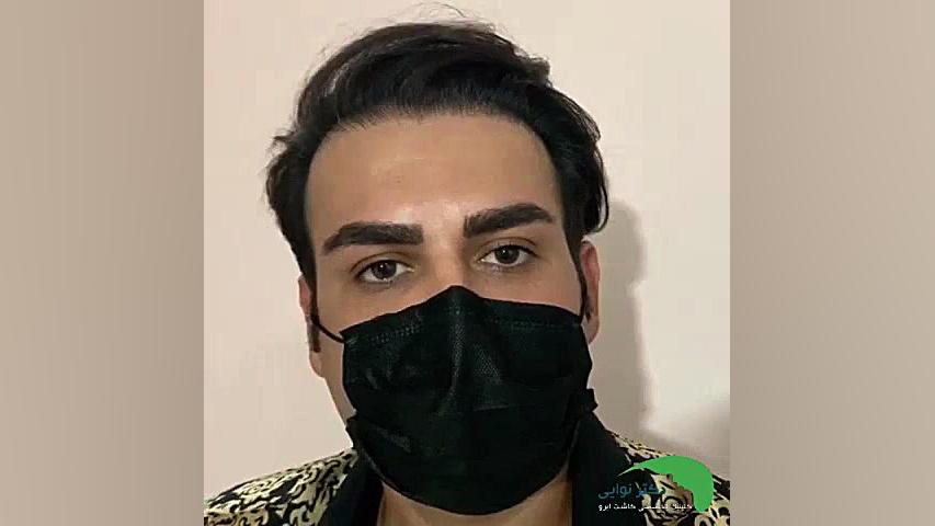 کاشت ابرو آقایان پریودنتیکس