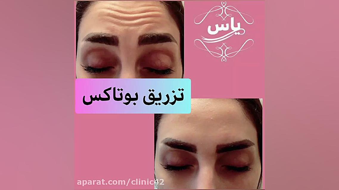 فیلم تزریق بوتاکس مجموعه پوست مو زیبایی شریعتی 02126415340 هشتگ