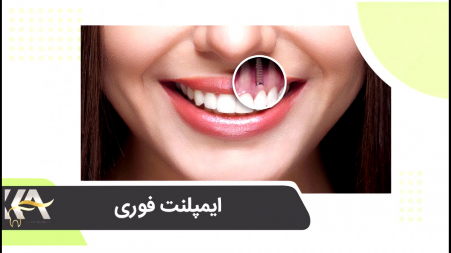 ایمپلنت فوری چیست؟ دکتر کامیار عباسی