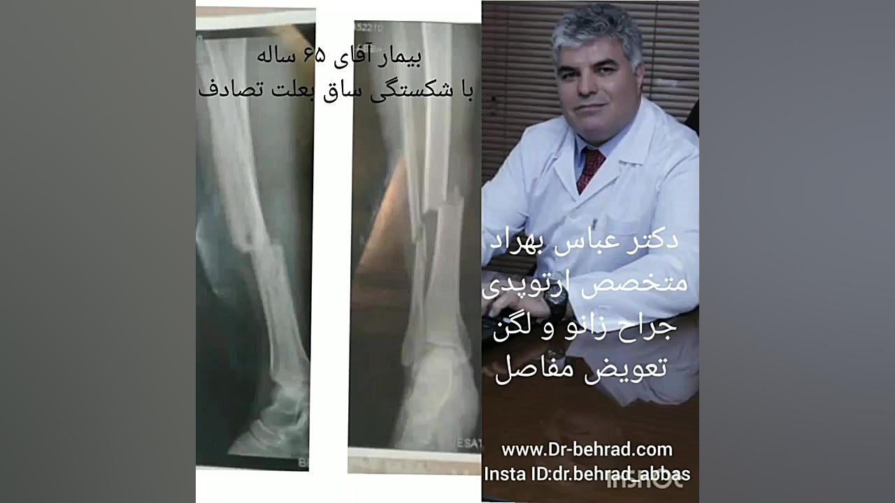 دکتر عباس بهراد جراح زانو و لگن جراحی شکستگی ساق اصلاح فرم صورت