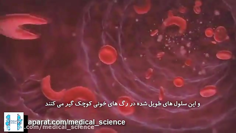 کم خونی داسی شکل (Sickle Cell Anemia) جوانسازی پوست