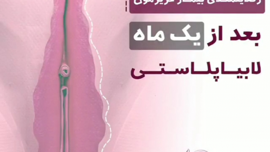 فیلم رضایتمندی از عمل لابیاپلاستی با دکتر حبیبه احمدی کامپوزیت ونیر