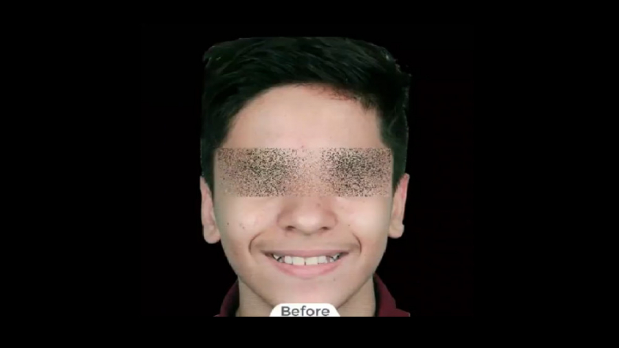 ارتودنسی ثابت دو فک بدون کشیدن دندان دکتر برهمن سبزواری - متخصص ارتودنسی - مشهد