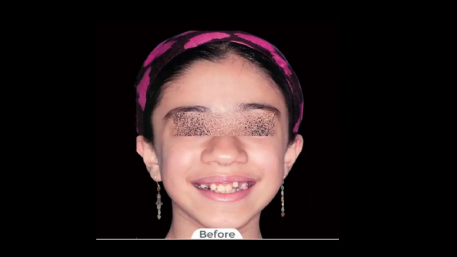 ارتودنسی در یک نوجوان دچار مشکل اسکلتی عقب بودن فک بالا دکتر برهمن سبزواری - متخصص ارتودنسی - مشهد